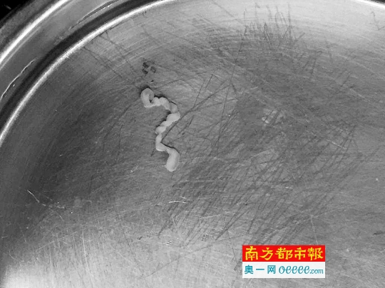 这条虫子,一度让病人被诊断长了恶性肿瘤.通讯员图