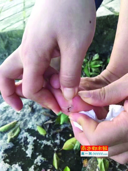 陈虹的脚底被扎伤.受访者供图